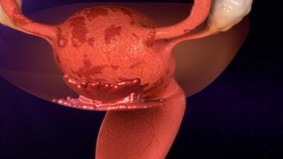 En què consisteix l’endometriosi?