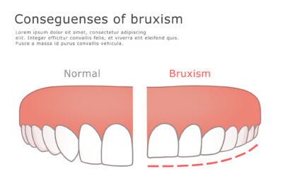 Les causes del bruxisme i les seves conseqüències